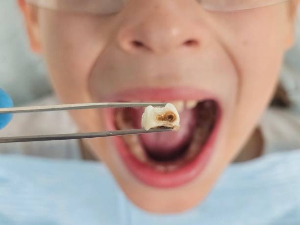 Best Emergency Wisdom Teeth Removal in Lake Telemark, NJ